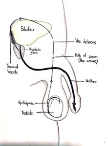 13 Kallman Syndrome